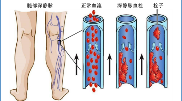 【微创介入】腿部肿胀？疼痛？皮肤颜色变红？……可能是下肢深静脉血栓“找上门了”
